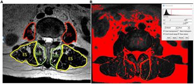 Lumbar posterior group muscle degeneration: Influencing factors of adjacent vertebral body re-fracture after percutaneous vertebroplasty